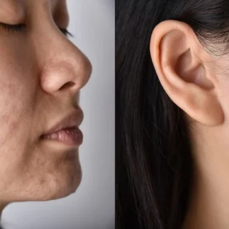 Image for Transform Your Skin: The Power of Medical Grade Peels in Banishing Acne Scars