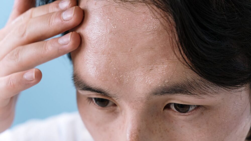 Image for Hyperhidrosis: Symptoms, Causes and Remedies